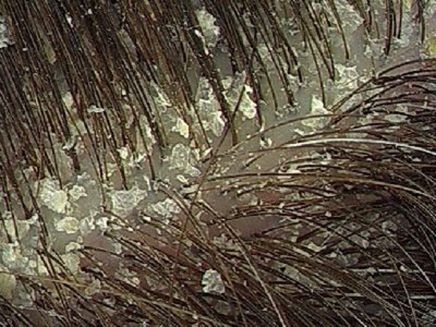 <p>Thin, dry, or oily plate of epidermal flakes, excessive Dandruff</p>