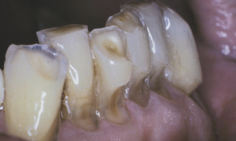 <p>tooth-abrasive (mechanical)</p>