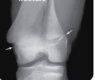 <p>occur where bone matrix is undergoing calcification; unless carefully treated, fractures between epiphysis and epiphyseal cartilage can permanently stop growth</p>