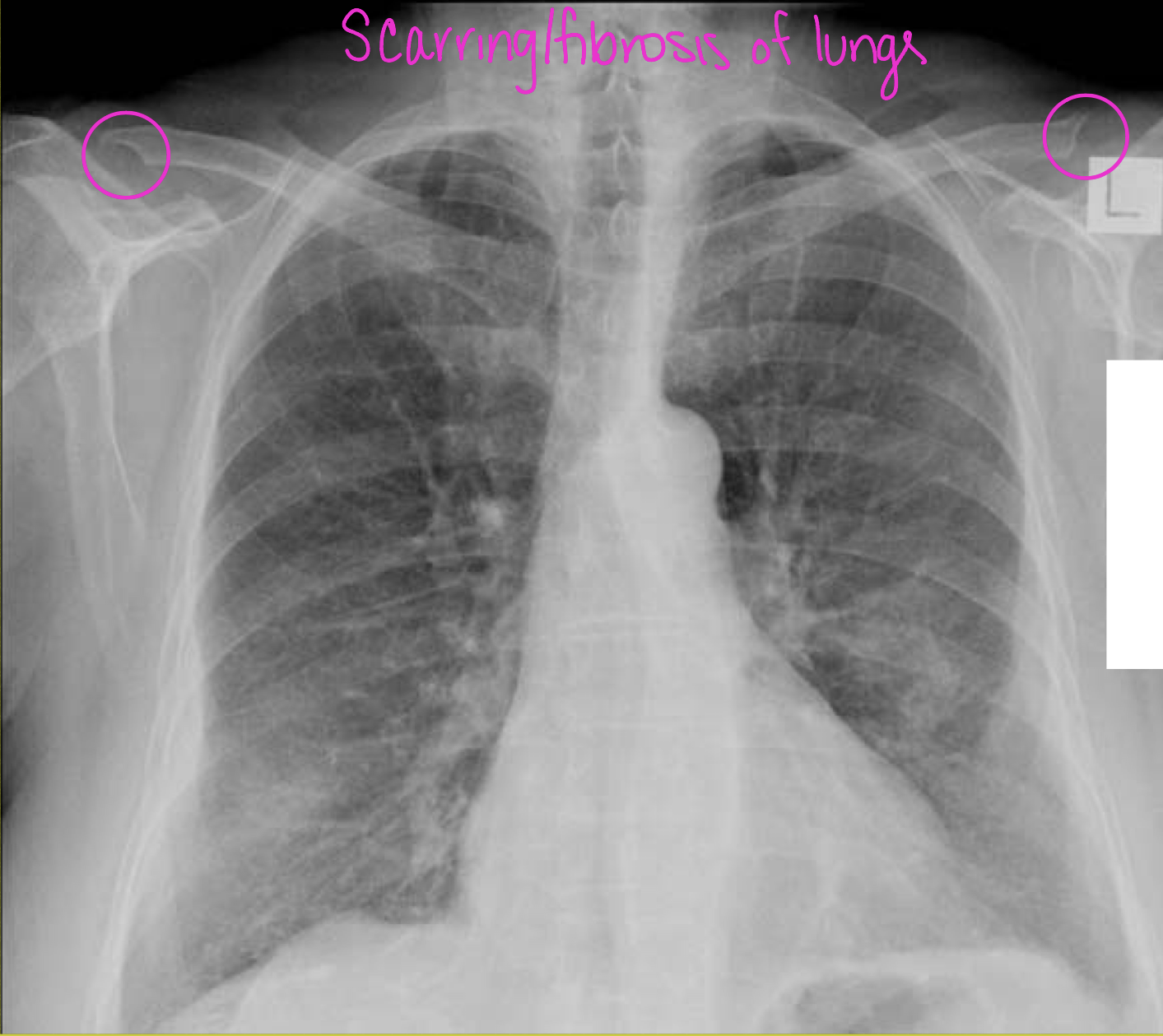 <p>What are some ddx for clavicle erosions</p>