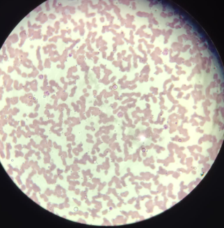 <p>Blood Film - Wright-Giemsa</p><ul><li><p>blood is a liquid connective tissue</p></li><li><p>extracellular matrix is liquid called blood plasma</p></li><li><p>blood plasma contains water and organic and non organic components</p></li><li><p>RBC - males (4-6×10^12 cells/L) Females (3.5-5.5 ×10^12 cells/L)</p></li><li><p>Erythrocytes are cells without nucleus, but have a lot of hemoglobin inside</p></li><li><p>on top of erythrocytes has a lot of factors (blood lines factors, A Group, B Group, AB Group, and O group)</p></li><li><p>has also rhesus factor</p></li><li><p>WBC - 4-10×10^9 Cells / L, all has nucleus, and all has lysosome (phagocytic cells)</p></li><li><p>granulocytes:</p><ul><li><p>Neutrophils (55-60%) -  contains segmented low nucleus (3-5), has granules but not stained</p></li><li><p>Eosinophils (2-4% or 1-3%) - specific cells, they will not divide in the blood stream</p></li><li><p>Basophils (0.1-1%) - biggest granulocytes, contains granules which are stained, contains inside hestamine and serotonin inflamatory cells  </p></li></ul></li><li><p>Agranulocytes:</p><ul><li><p>Lymphocytes - built of B and T cells Ratio (20-80%), B cells don’t produce antibodies, they have the ability to turn inside the plasmacytes the one which are going to produce the antibody. They have the ability to differentiate</p></li><li><p>monocytes (4-5%) - the biggest white blood cells macrophages, kidney shaped nucleus, phagocytic cell  has the ability to migrate closer to connective tissue</p></li><li><p>platelets - are not cells (200-400×10^9 Units/Liter) </p></li></ul></li></ul><p></p><p></p>