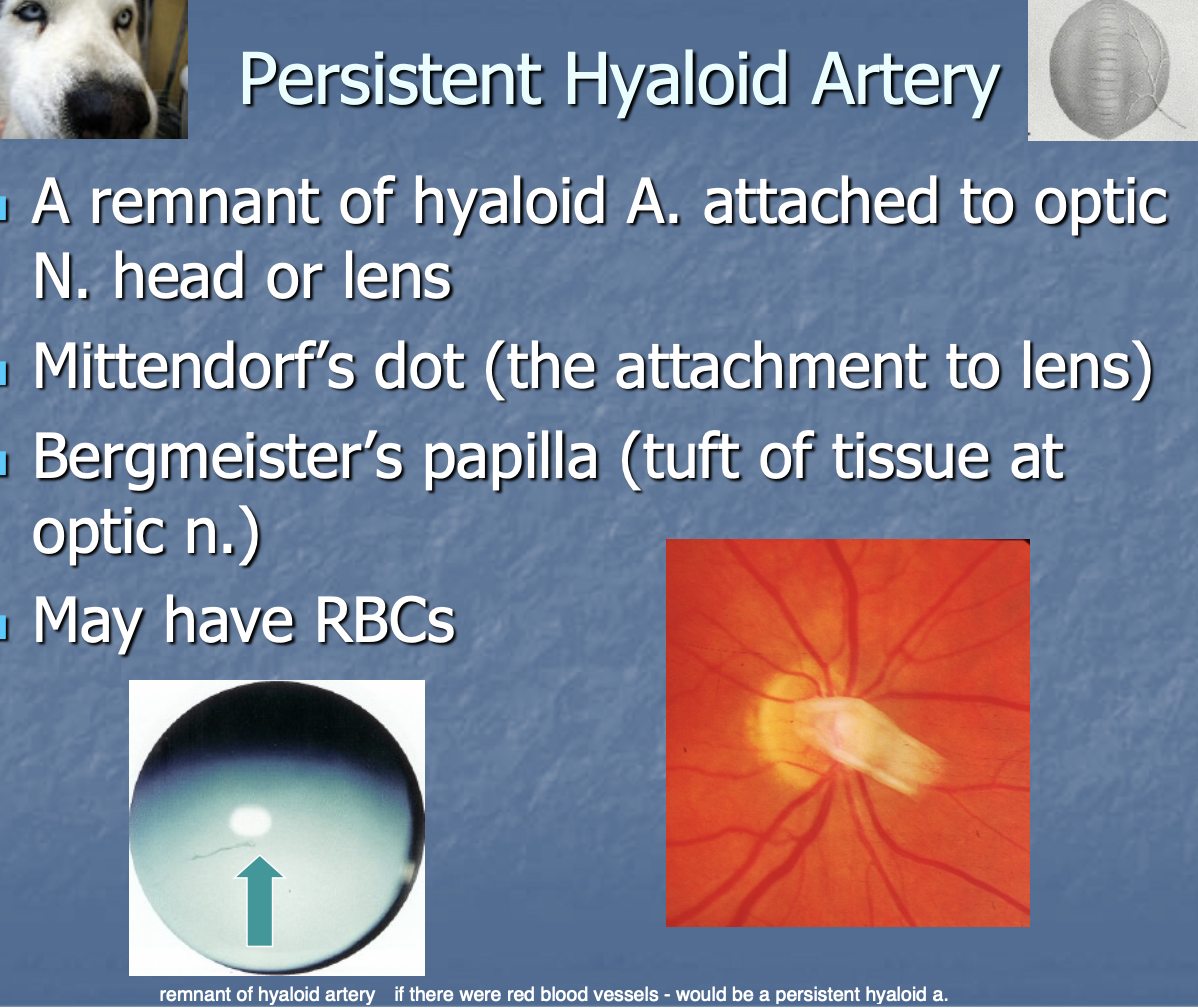 <p>a remnant of hyaloid a. attached to optic n. head or lens.</p>