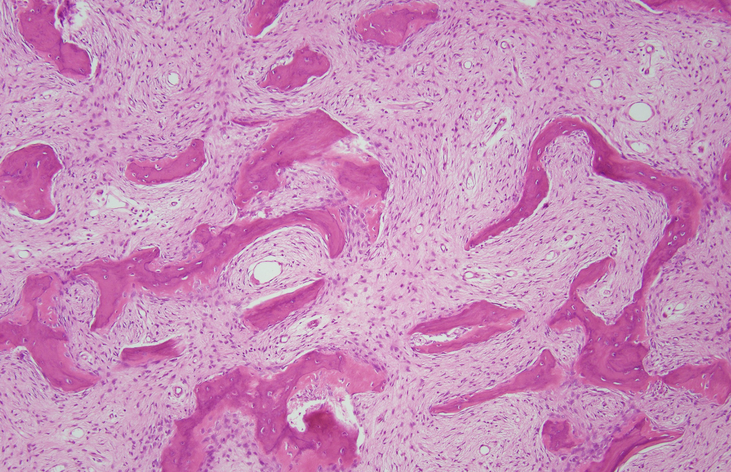 <p>Tumeur intramédullaire tibian enfant</p><p>diagnostic</p><p>définition</p><p>age</p><p>topographie</p><p>anatomie</p><p>histologie</p><p>IHC moléculaire</p><p>syndromes</p>