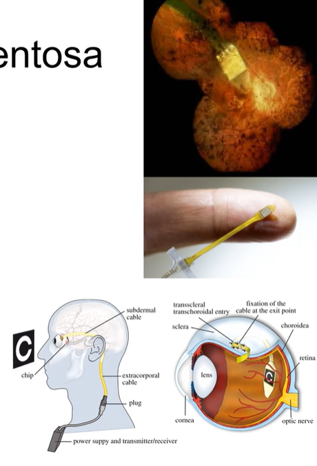 <ul><li><p>Exclude systemic associations:</p><ul><li><p>Bassen-Kornzweig syndrome (deficiency in beta-lipoprotein)</p></li><li><p>Refsum disease (deficiency in the enzyme phytanic acid 2- hydroxylase)</p></li><li><p>Usher syndrome (combined deafness and RP)</p></li><li><p>Kearns- Sayre (mitochondrial cytopathy)-refer to cardiologist (danger of complete heart block)</p></li><li><p>Bardet-Biedl syndrome (mental handicap, polydactily, obesity, hypogenitalism, RP)</p></li></ul></li><li><p>No definitive treatment for RP: gene editing/ stem cell treatment ongoing trials with promising results (not all approved yet)</p></li><li><p>Artificial retinal implants, show promise</p><ul><li><p>Can send signals to retina to create some light perception→ can improve ability to read</p></li></ul></li></ul><p></p>