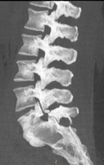 <p>6-7% of general population, 7-21% adolescent athletes</p><p>Risk factors: contact sports with repetitive hyperextension</p><p>L5 (80%), anterolithesis of L5 relative to S1</p>