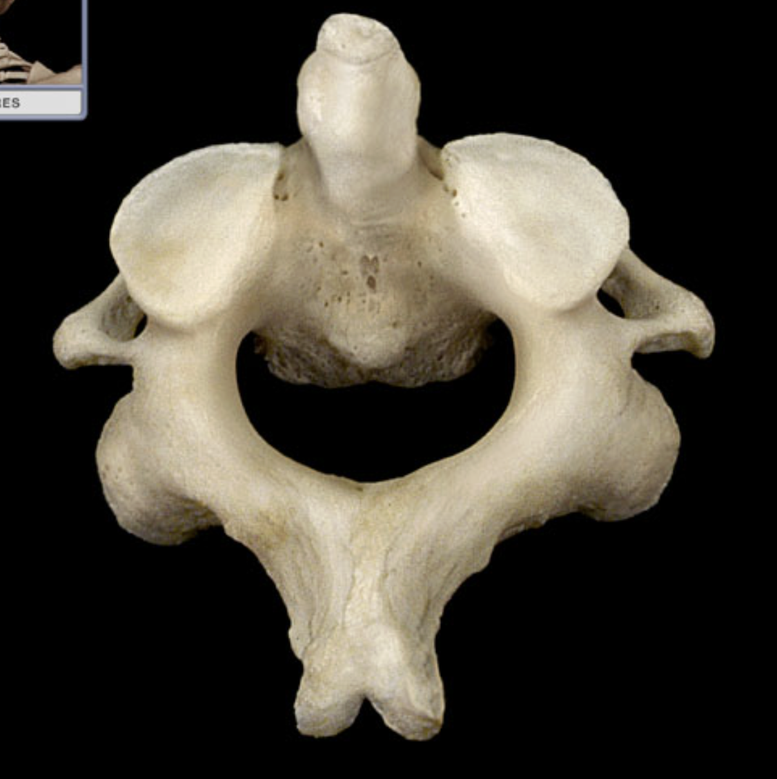 <ul><li><p>also known as c2</p></li><li><p>second vertebrae</p></li><li><p>part of cervical vertebrae</p></li><li><p>contains transverse process, spinous process, transverse foramen, vertebral foramen, and dens</p></li></ul><p></p>