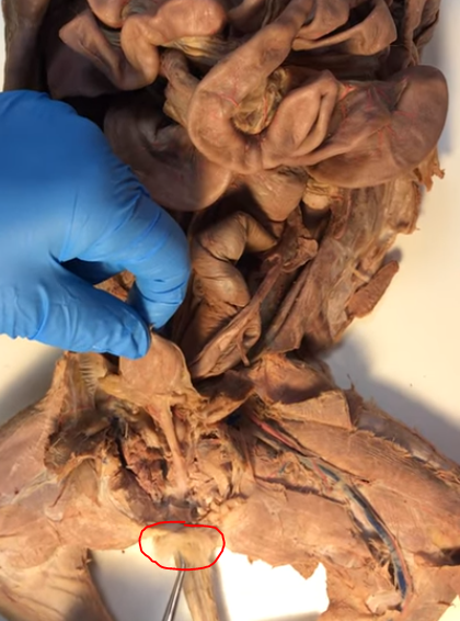 <p>What is this structure that surrounds the urogenital sinus</p>
