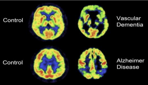 <p>Vascular Dementia( Multi-infarct Dementia) </p>