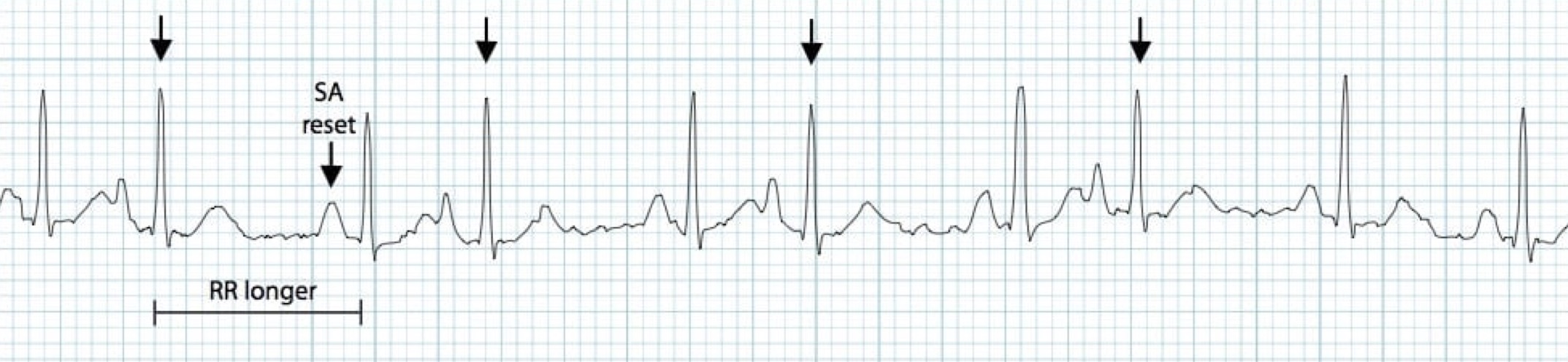 <p>What rhythm/abnormality is seen below?</p>
