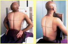 <p>PA chest x-ray variation where the patient sits on the edge of the gurney and bends forward with the hips towards the IR or sits erect and holds the IR</p>