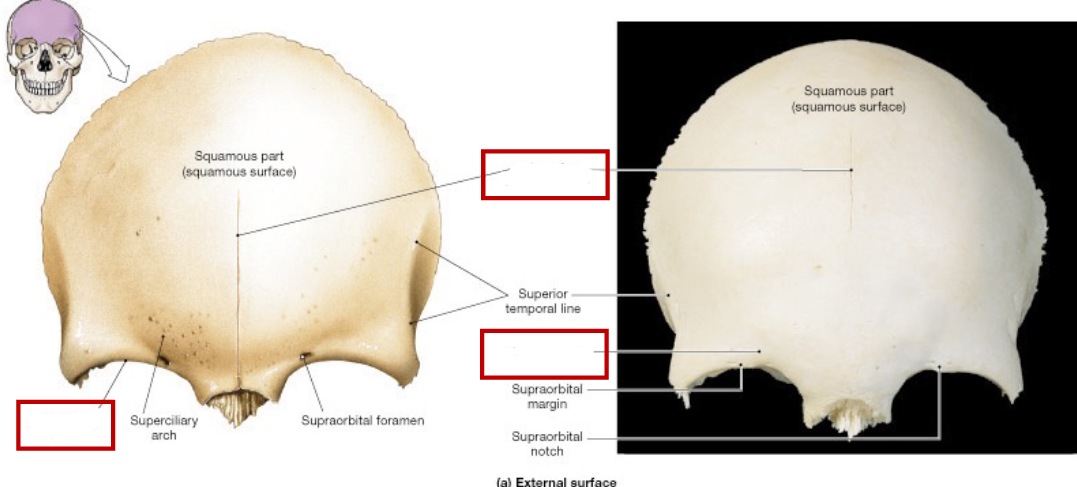 <p>Frontal bone (braincase), fill in the blanks. </p><p>an ectocranial view anterior</p>