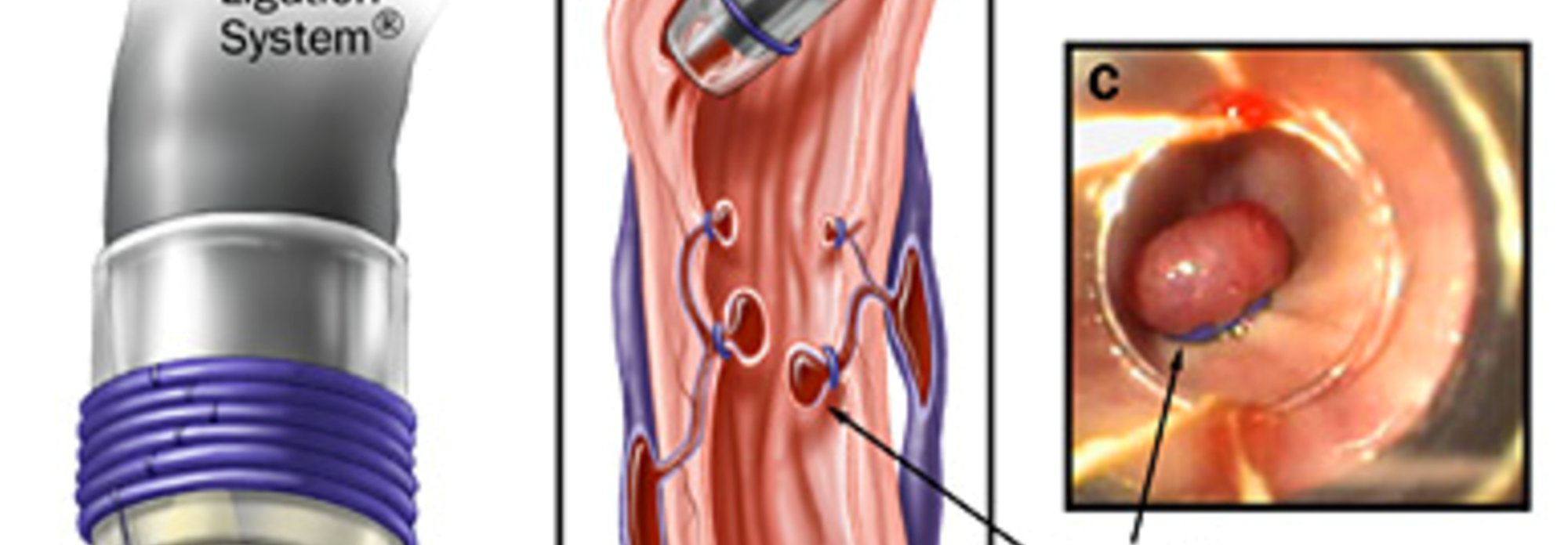 <p>controls bleeding</p><p>lowre mortality</p><p>fewer complications</p><p>fewer sessions</p>