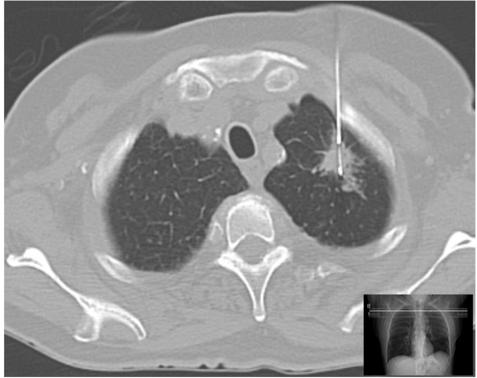 <p>Needle guided by CT for peripheral lesions</p>