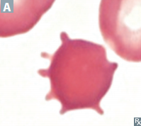 <p>"Spur cells" — RBCs with irregularly spaced projections of varying size</p>