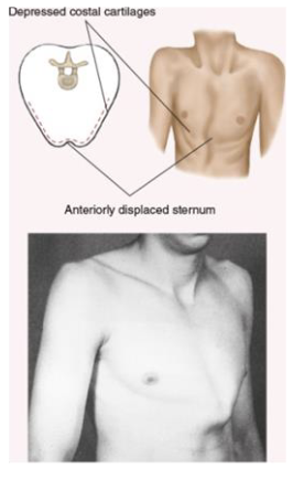<p>everted sternum (protruding skin)</p>