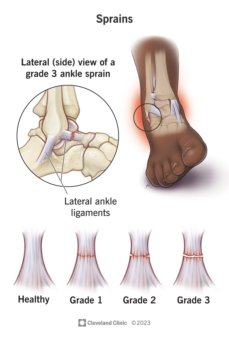 <p>Sprain</p><ul><li><p>Ligaments ONLY</p></li></ul><p></p>