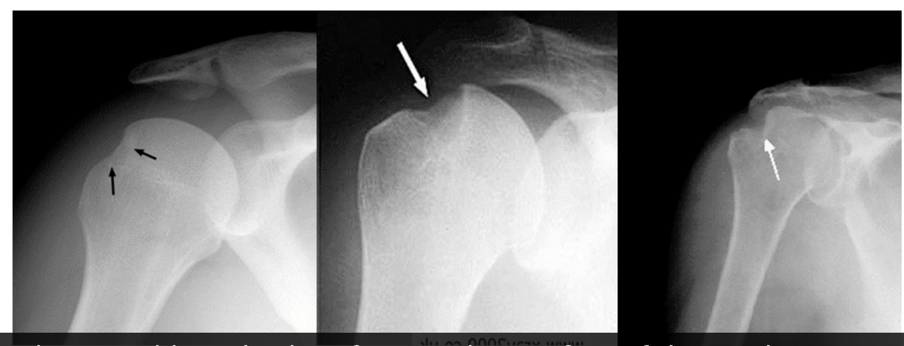 <ul><li><p><span>Common post-anterior dislocations</span></p></li><li><p><span>Often the result of an anterior dislocation</span></p></li><li><p><span>Caused by humeral head strikes inferior glenoid</span></p></li><li><p><span>Divot seen on superior posterior lateral aspect of humeral head</span></p></li></ul><p></p><p></p>