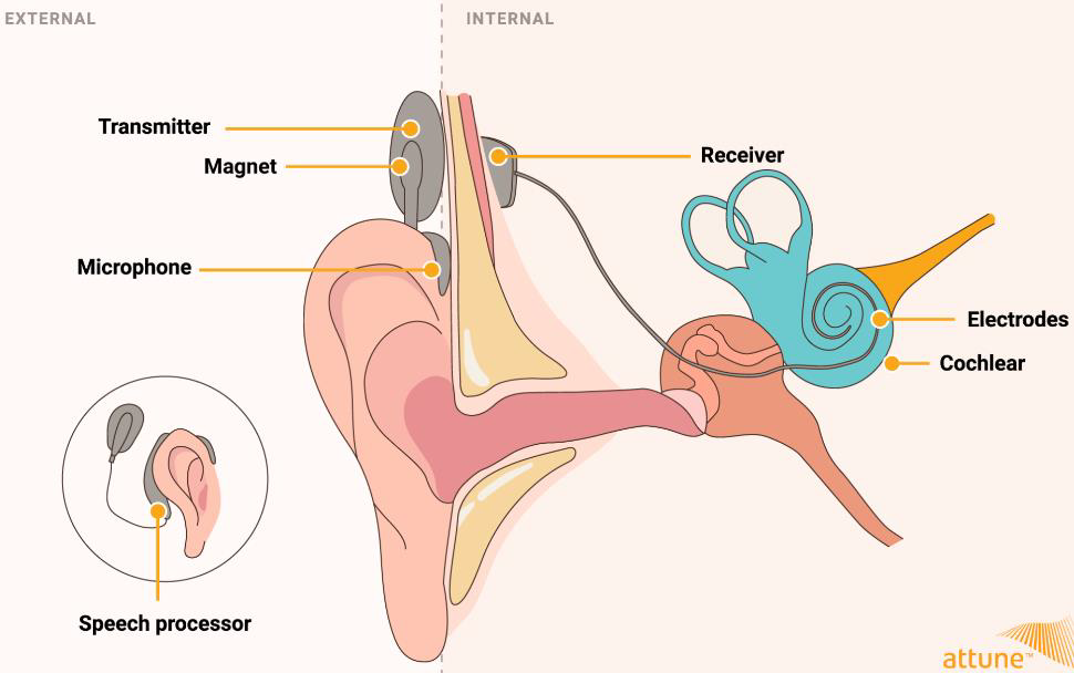 <ul><li><p>microphone worn in ear receives sound and transmits it to speech processor worn on skull → transforms acoustic signal to electrical</p></li><li><p>transmitting coil behind ear transmits the electrical impulses as radio frequencies through the skin to implanted cochlear receiver that stimulates auditory nerve</p></li></ul><p></p>