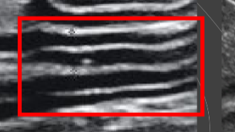 <p>What intestinal layer is significantly thickened in this ultrasound?</p>