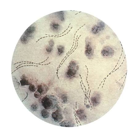 <p>What gram - fastidious coccobacillus bacteria causes chancroid?</p><p>-”School of fish” or “railroad track” appearance </p>