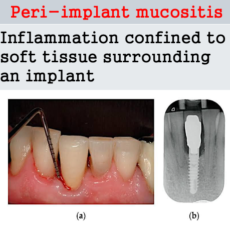 <p><span>Inflammation confined to soft tissue surrounding an implant</span></p>