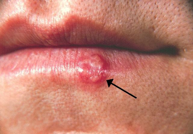 <p>Herpes simplex virus (HSV).</p>