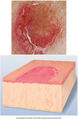 <p>Loss of part of the epidermis, depressed, moist, glistening, following rupture of a vesicle or bulla. Secondary Lesion.</p>