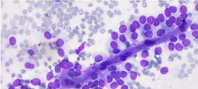 <p>Kyste du pancreas</p><p>1) diagnostic</p><p>2) morphologie</p><p>3) biochimie</p><p>4) altérations moléculaire</p><p>5) risque de malignité</p>