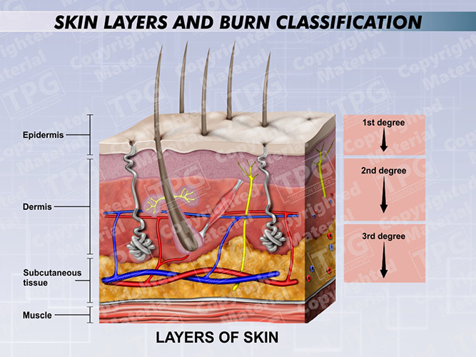 <p>Types of Burns</p>