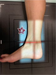 <p>kVp: 60-75</p><p>Grid: No</p><p>CR: directed at Medial Malleolus </p><p>Patient position: Patient in a lateral recumbent position, Flex affected limb 45˚, Dorsiflex foot so that plantar surface is at a right angle to leg or as far as patient can tolerate (DO NOT FORCE)</p><p>Evaluation criteria: Entire talus and calcaneus visualized, Lateral malleolus superimposed over posterior half of tibia</p>
