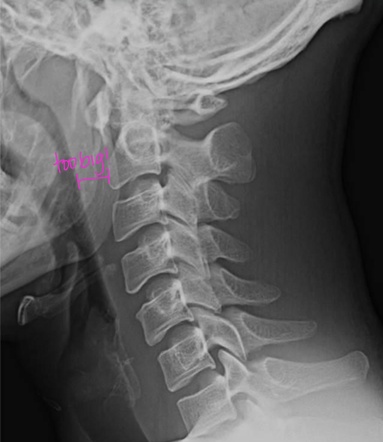 <p>If a patient was in a MVA, what should you think is causing the abnormal RPI or RTI</p>