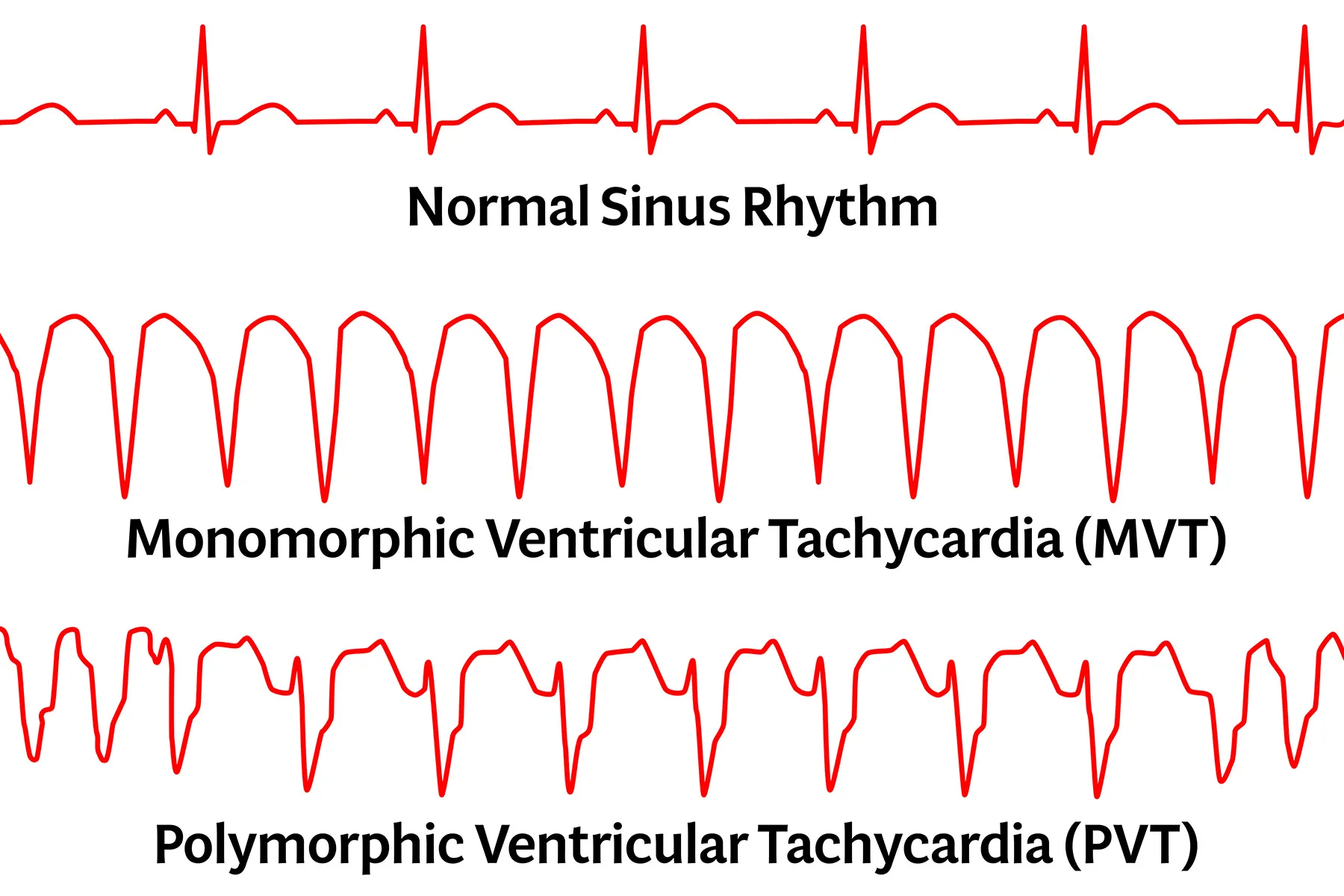 <p>Ventricular Tachycardia (VTach) A potentially life-threatening cardiac rhythm characterized by <strong>three or more consecutive ventricular beats at a rapid rate</strong>, typically originating from the ventricles. VTach may occur with a pulse or without a pulse and can reduce cardiac output or progress to ventricular fibrillation.</p>