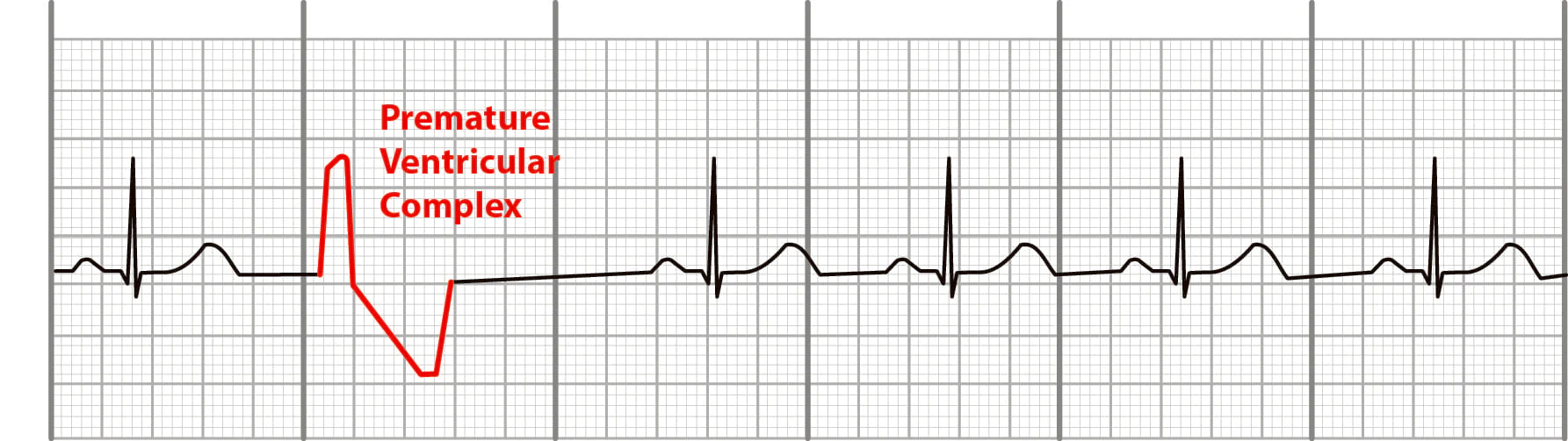 <p>management of ventricular premature beats </p>