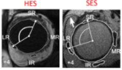 <p>a divergence insufficiency esotropia that presents similar to sagging eye syndrome but occurs in young adults. Occurs due to an elongated axial length (high myopia) causing superotemporal globe shift.</p>