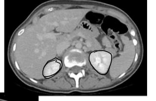 <p>last phase, 2 mins after venous</p><p>requires arterial venous iodine difference <10 Hus</p>