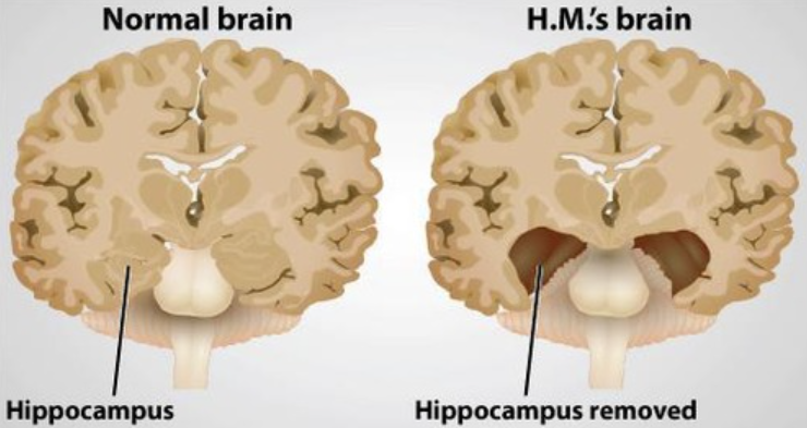 <p>Henry Molaison (HM)</p>