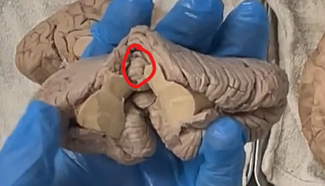 <p>lingula, feature of the superior vermis. </p><p>In neuroanatomy, the <strong>lingula</strong> is a <strong>small, tongue-shaped lobule of the cerebellar vermis</strong> located on the <strong>superior surface of the cerebellum</strong>.</p><ul><li><p>It is the <strong>most anterior (front-most) part of the vermis</strong></p></li><li><p>Lies just above the <strong>superior medullary velum</strong></p></li></ul><p><strong>Etymology</strong></p><ul><li><p><strong>Lingula</strong>: from Latin <em>lingula</em> = <strong>“little tongue”</strong></p></li></ul><p>Literal meaning:<br><strong>“small tongue-like structure.”</strong></p>