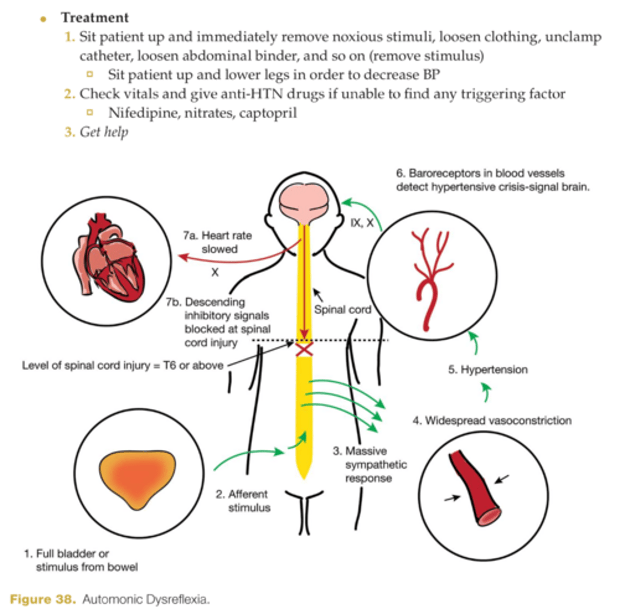 <p>occurs with injuries at or above T6 --> disruption of sympathetic response</p><p>-MEDICAL EMERGENCY</p><p>-vasoconstriction occurs leading to hypertension and decreased HR</p><p>-increased BP, decreased HR, headache, flushing, profuse sweating, anxiety, constricted pupils, blurred vision, piloerection</p><p>-systolic increases by 20-30</p><p>-vasoconstriction below level of injury and vasodilation above</p>