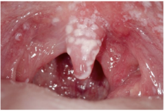 <p>Give an example of an opportunistic fungal pathogen and the infections it causes.</p>