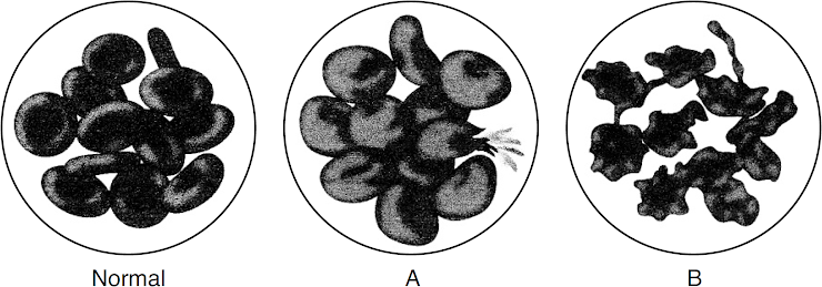 <p><span style="line-height: 1.5;">The diagram represents three groups of red blood cells. Groups<em>&nbsp;A&nbsp;</em>and&nbsp;<em>B</em>&nbsp;were each placed in different solutions for the same period of time.&nbsp;Identify which group of cells,&nbsp;<em>A</em>&nbsp;or&nbsp;<em>B</em>, had most likely been placed in distilled water.</span></p>