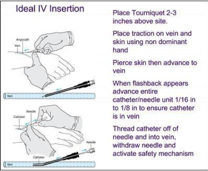 <p>You will learn this</p><p class="p1">in Nursing 5</p><p class="p2">• Intravenous devices provide</p><p class="p2">access to the venous system for</p><p class="p2">fluid delivery</p><p class="p2">• Various catheters available</p><p class="p2">• BEVEL UP!!!</p>