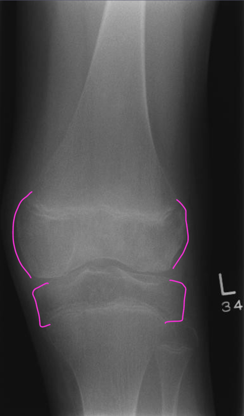 <p>What JCA two radiological findings are in this image</p>