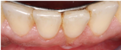 <p>What most likely caused the gingival recession?</p>