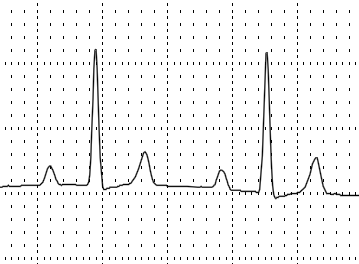 <p>Supraventricular</p>