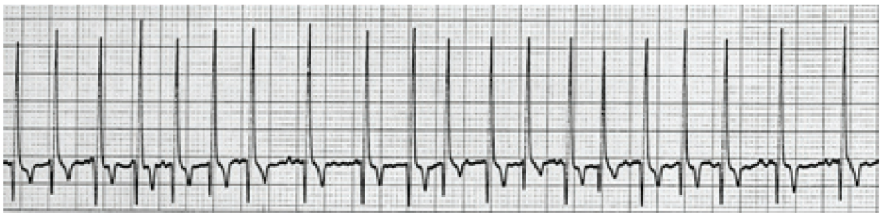<p>Atrial fibrillation (A-Fib) </p><p>• Definition: Disorganized atrial electrical activity causing ineffective atrial contraction and irregular ventricular</p><p>response.</p><p>• ECG features: No distinct P waves (replaced by fibrillatory waves), irregularly irregular R-R intervals, ventricular</p><p>rate often rapid (tachycardic).</p>
