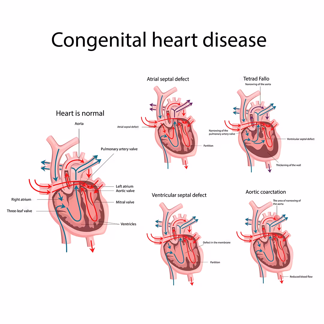 <p>congenital heart disease (CHD)</p>