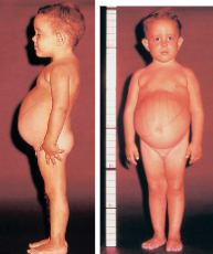 <ul><li><p><strong>inc. G-6P in liver cells</strong> (muscles spared)  → <strong>hypoglycemia</strong> (early death, seizures), <strong>lactic acidosis,</strong> liver enzymes normal</p></li><li><p>type IA (<strong>G-6Pase def.</strong>)</p><ul><li><p>hepato/renomegaly, <strong>doll like face</strong></p></li><li><p>need NGT tube for glucose</p></li></ul></li><li><p>type IB (<strong>G-6P transporter def.</strong>)</p><ul><li><p>diarrhea, bruising, neutropenia</p></li></ul></li></ul><p></p>