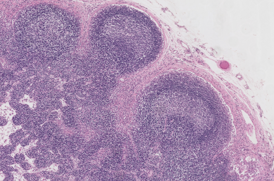 <p><span>Which of the following is true regarding the image of the lymph node?</span></p><p>-The nodules/follicles are secondary, so the lymph node is responding to antigens.</p><p>-The nodules/follicles are secondary, so the lymph node is not responding to antigens.</p><p>-The nodules/follicles are primary , so the lymph node is responding to antigens.</p><p>-The nodules/follicles are primary, so the lymph node is not responding to antigens.</p>