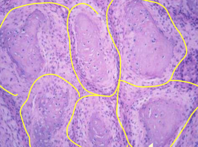 <p>multilobar tumour of bone, slow growing and locally invasive, affects flat bones like the skull, sometimes ribs and pelvis </p><p>can invade to the brain </p><p>flat bone and locally invasive </p>
