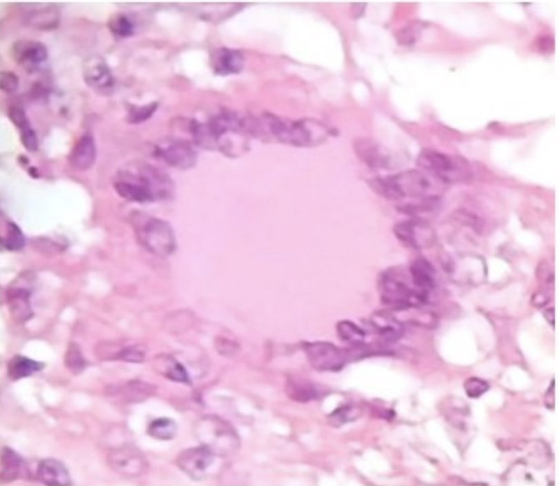<p>Central collection of histiocytes/macrophages ± multinucleated giant cells, surrounded by lymphocytes; represents cell-mediated immune response</p>